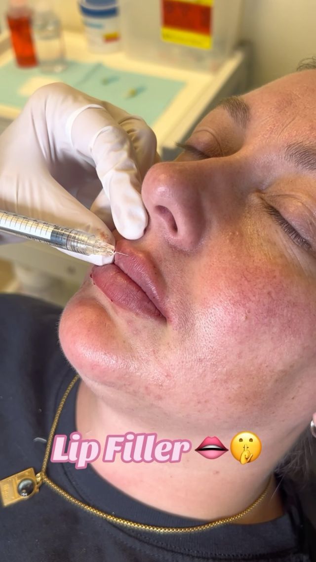 Lip Filler ✨💋 // #lipfiller #enhancement

RESULTS 💉👄 
✨Enhanced Volume & Definition 
✨Smoother, Wrinkle-Free Lips 
✨Natural-Looking Results

BONUS 🌟 If you want to tackle wrinkles and fine lines, Botox is a great option! It works by blocking nerve signals to reduce muscle movement and lessen the appearance of wrinkles.

Visit our website, drstoker.com, to view striking before and after photos and discover our full range of rejuvenation services. Start your journey to a more youthful look today!

👋BOOK NOW | in-office or virtual appointments by sending your name, number, and email to the DM. 

📲 CALL US | questions regarding treatment: (310) 300-1779

📩Email: Info@drstoker.com

🛍 SHOP SKINCARE | Link in bio 🔗

COMMENT BELOW 🔽
.
.
.
.
#lipfillerbeforeandafter #dermalfiller #cosmeticinjector #juvederm #restylanel #juvedermultra  #fillers #filler #lipflip #plumplips #lipaugmentation #lipfillers #lipenhancement #antiaging #aesthetics #lipgoals #lipenvy #skin #injectables #plasticsurgery #cheekfiller #lips #aestheticsexpert #selfcare #beforeandafter #skincareroutine