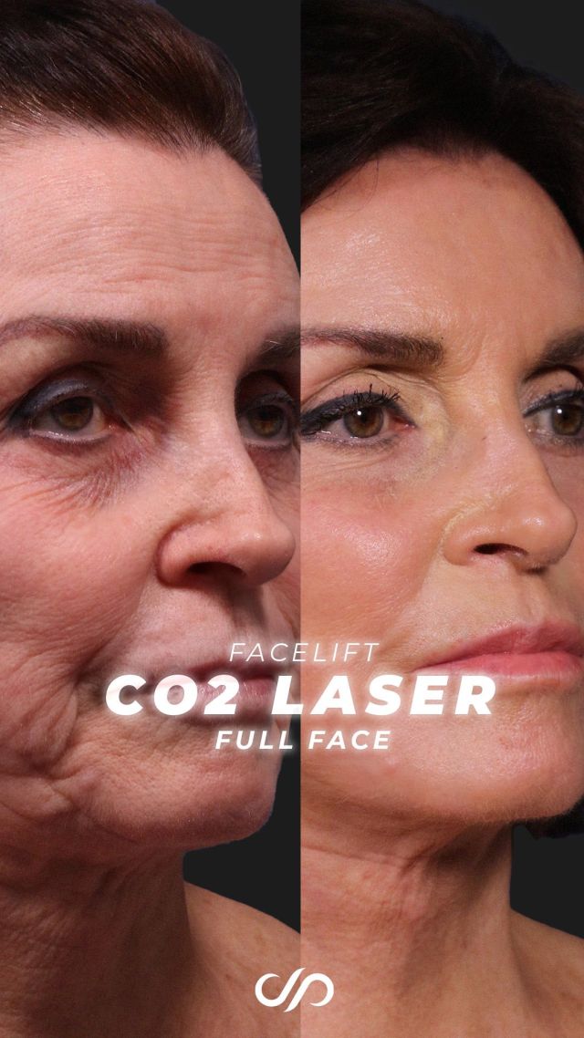 Unbelievable Traceless Facelift // CO2 Laser 💁‍♀️✨// #facelift 

💞We’re excited to showcase the results of our 78-year-old patient, three months post-op from her third facelift. A former model, she first had a facelift 40 years ago and another 20 years ago, but this one is by far the best.

💞Her transformation is incredible. Her deep folds around the mouth are smoothed, fine lines softened, and her jawline beautifully redefined. The skin around her eyes and brow shows a remarkable improvement, with fewer wrinkles and a refreshed, youthful texture. She walked in radiating joy, and we’re thrilled with her stunning results.

👋BOOK NOW | in-office or virtual appointments by sending your name, number, and email to the DM. 

📲 CALL US | questions regarding treatment: (310) 300-1779

📩Email: Info@drstoker.com

🛍 SHOP SKINCARE | Link in bio 🔗

COMMENT BELOW 🔽
.
.
.
.
#rejuvenation #tracelessfacelift #faceliftexpert  #skincare #cheeklift #lowerfacelift #laserskinresurfacing #blepharoplasty #upperbleph #uppereyelid #eyelidsurgery  #co2 #chinaugmentation #skinrejuvenation #skintightening  #cosmeticsurgery #wrinkles  #surgery #rejuvenation #skin  #antiaging #plasticsurgeon #transformation #plasticsurgery