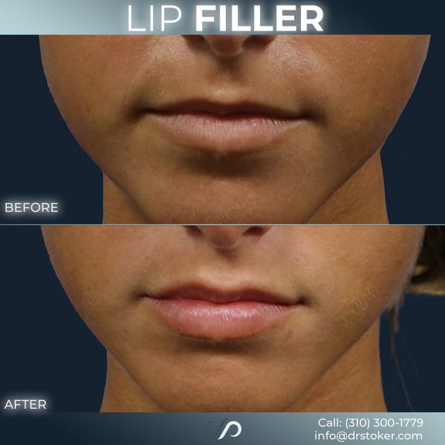 Lip Filler ✨💋 // #lipfiller #enhancement 

Benefits of Lip Filler 💉👄
✨Improved Volume & Definition
✨Smoothed Out Wrinkled Lips
✨Natural-Appearing Results 

BONUS 🌟
Looking to address wrinkles and fine lines? Consider the popular choice of Botox! By blocking nerve signals, Botox reduces muscle movement and diminishes the appearance of wrinkles. Explore our website, drstoker.com, to see impressive before and after photos and learn about our range of rejuvenation services. Take the first step towards a more youthful you!

BOOK NOW | in-office or virtual appointments by sending your name, number, and email to the DM. 

📲 CALL US | questions regarding treatment: (310) 300-1779

📩Email: Info@drstoker.com

🛍 SHOP SKINCARE | Link in bio 🔗

COMMENT BELOW 🔽
.
.
.
.
#lipfillerbeforeandafter #dermalfiller #cosmeticinjector #juvederm #restylanel #juvedermultra  #fillers #filler #lipflip #plumplips #lipaugmentation #lipfillers #lipenhancement #antiaging #aesthetics #lipgoals #lipenvy #skin #injectables #plasticsurgery #cheekfiller #lips #aestheticsexpert #selfcare #beforeandafter #skincareroutine