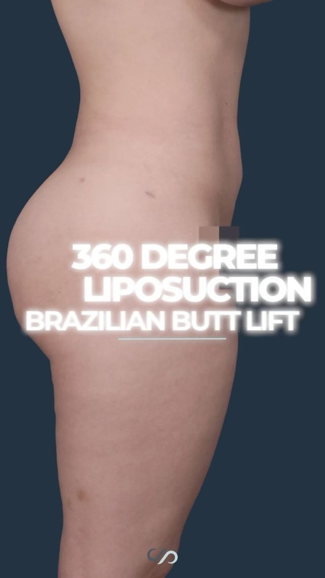 360 Liposuction // BBL 👙✨🍑 // #bbl #liposuction 

💞 Body contouring with liposuction is a transformative solution for stubborn, diet-resistant fat, a problem that often becomes more pronounced with age. 

💕In addition to removing unwanted fat, liposuction allows for targeted fat transfer, as seen in procedures like the Brazilian Butt Lift. This approach shapes and refines the body, delivering a more sculpted, balanced look.

👋BOOK NOW | In-office or virtual appointments by sending your name, number, and email to the DM. 

📲 CALL US | questions regarding treatment: (310) 300-1779

📩Email: Info@drstoker.com

🛍 SHOP SKINCARE | Link in bio 🔗

COMMENT BELOW 🔽 .
.
.
.
#skintightening #abdominoplasty #bodytransformation #plasticsurgery #lowerbody #plasticsurgeon #extendedabdominoplasty  #cosmeticsurgery #surgery #mommymakeover #bodycontouring #breastaugmentation #breastlift  #weightloss #extrememakeover #weightlosstransformation #beforeandafter #bodycontouring #recovery #recoverytime #downtime #body #drstoker #boardcertifiedplasticsurgeon #postopcare #bodyshaping #fitness