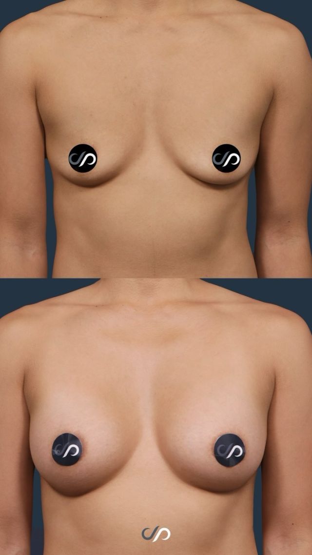 Breast Augmentation❣️🍒❣️ // #breastimplants #enhancement 

Benefits✨
💕 Achieve a Natural, Balanced Look
💕 Sculpt and Define Your Silhouette
💕 Enhance Clothing Fit and Comfort
💕 Boost Confidence in Your Appearance

💞 Breast augmentation offers a quick recovery, with most patients returning to work within one to two days, even those with non-physical jobs. Some even feel well enough to go out to dinner afterward. Recovery times can vary, and we’ll work closely with you to ensure the best post-surgery care for your needs.

✅ BOOK NOW | in-office or virtual appointments by sending your name, number, and email to the DM.

📲 CALL US | questions regarding treatment: (310) 300-1779

🛍 SHOP SKINCARE | Link in bio 🔗

COMMENT BELOW ⬇️  .
.
.
.
#breastaugmentation #boobjob #breastimplants #gummybearimplants #breastenlargement #beforeandafter #breastsurgery #breastimplant #cosmeticsurgery #plasticsurgery #boobjobexpert #breastaugmentationexpert #boardcertified #boardcertifiedplasticsurgeon #mastopexy #breastaug #breastreconstruction #plasticsurgeon #breastlift #postop #postopsurgery #beforeandaftersurgery