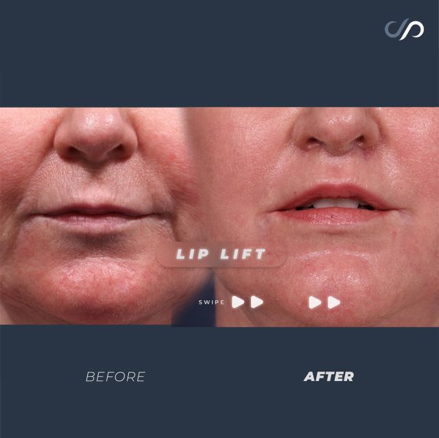 Lip Lift Results ☝️👄✨// #rejuvenation

👋 A lip lift enhances lip definition by shortening the space between the upper lip and nose, revealing a more pronounced vermilion border. This procedure creates fuller, youthful lips and reduces the need for dermal fillers, complementing the overall rejuvenation of a facelift.

RESULTS 🙌
🌹 Enhanced Lip Shape & Volume
🌹 Natural & Youthful Look
🌹 Improved Symmetry 

⭐️BOOK NOW | In-office or virtual appointments by sending your name, number, and email to the DM.

📲 CALL US | questions regarding treatment: (310) 300-1779

🛍 SHOP SKINCARE | Link in bio 🔗

COMMENT BELOW ⬇️ 
.
.
.
.
#tracelessfacelift #facelift #necklift #skincare #cheeklift #lowerfacelift #laserskinresurfacing #blepharoplasty #upperbleph #uppereyelid #eyelidsurgery  #co2 #chinaugmentation #skinrejuvenation #skintightening