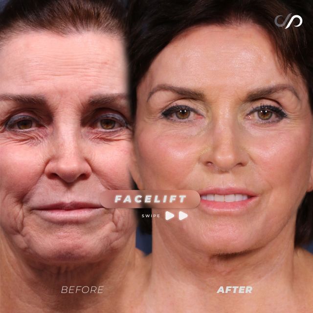 Life-Changing Traceless Facelift 🙋‍♀️🤯// #facelift 

✨We’re excited to share the remarkable results of our 78-year-old patient, three months after her third facelift. A former model, she’s achieved the best outcome yet, with smoother smile lines, softened wrinkles, and a more defined jawline. Her skin looks rejuvenated, and she radiates joy. We’re thrilled with her transformation.

👋BOOK NOW | in-office or virtual appointments by sending your name, number, and email to the DM. 

📲 CALL US | questions regarding treatment: (310) 300-1779

📩Email: Info@drstoker.com

🛍 SHOP SKINCARE | Link in bio 🔗

COMMENT BELOW 🔽
.
.
.
.
#rejuvenation #tracelessfacelift #faceliftexpert  #skincare #cheeklift #lowerfacelift #laserskinresurfacing #blepharoplasty #upperbleph #uppereyelid #eyelidsurgery  #co2 #chinaugmentation #skinrejuvenation #skintightening  #cosmeticsurgery #wrinkles  #surgery #rejuvenation #skin  #antiaging #plasticsurgeon #transformation #plasticsurgery