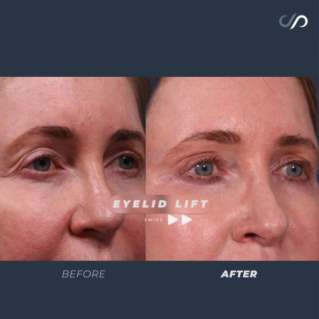 Traceless Eyelid Lift 👁️🌟// #eyelidlift 

RESULTS
💞 Enhanced Eye Shape & Brightness
💞 Minimal Visible Incisions
💞 Diminished Wrinkling

💕 Our patient had an upper eyelid lift, and the results are stunning. The light now beautifully reflects off her eyes, enhancing their natural sparkle. Combined with fractional CO2 laser, we’ve achieved smooth, youthful skin with minimal scarring. Even at 7 weeks post-procedure, the results are remarkable!

👋 BOOK NOW | In-office or virtual appointments by sending your name, number, and email to the DM. 

📲 CALL US | questions regarding treatment: (310) 300-1779

📩Email: Info@drstoker.com

🛍 SHOP SKINCARE | Link in bio 🔗

COMMENT BELOW 🔽
.
.
.
.
#blepharoplasty #plasticsurgery #facelift #eyelidsurgery #eyelift#blepharoplastysurgeon  #eyelidrejuventation #upperblepharoplasty #upperbleph #uppereyelids #antiaging #eyes  #facialrejuvenation #facialplasticsurgery #lowerbleph #cosmeticsurgery #plasticsurgeon #surgery #beauty #skintightening #beforeandafter #aesthetic #maleplasticsurgery #drstoker #boardcertified #boardcertifiedplasticsurgeon #hollywood #beverlyhills