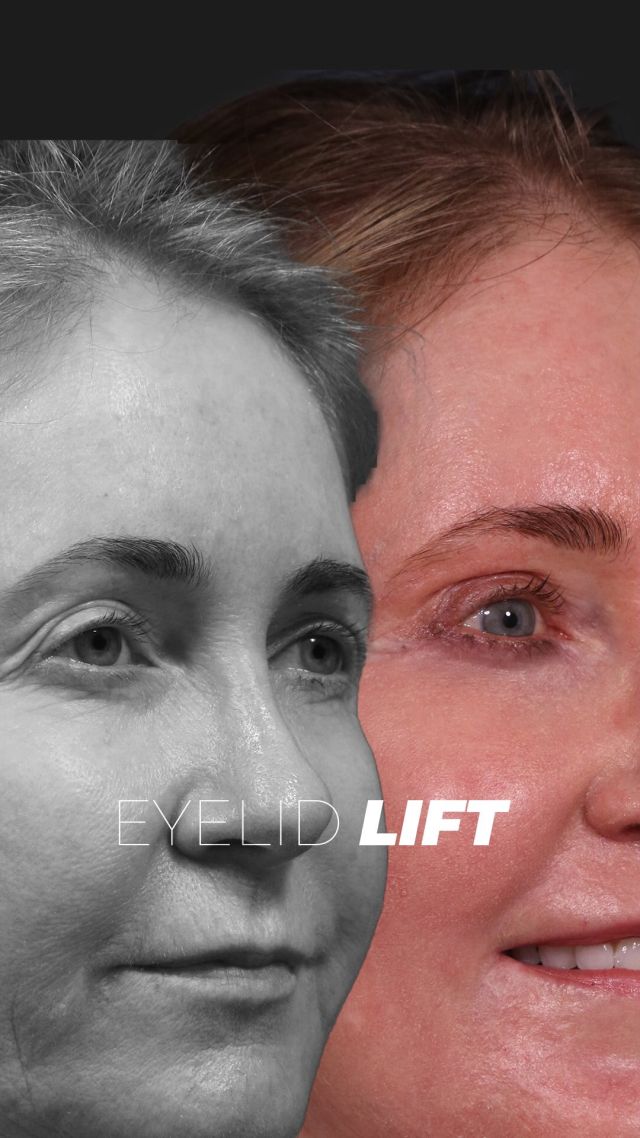 Eyelid Lift w/ CO2 Laser 🌟😉🌟// #eyelidlift 

RESULTS
✨ Enhanced Eye Shape & Brightness
✨ Smoother, Wrinkle-Free Skin
✨ Minimal Visible Incisions
✨ Reduced Puffiness
✨ Youthful, Refreshed Look

💖Check out our patient’s stunning blue eyes! After treatment, light now reflects beautifully off her eyes, bringing out their natural sparkle.

💖 With fractional CO2 laser, we’ve achieved smooth, youthful skin with minimal incisions. Even at 7 weeks post-procedure, the results are amazing!

👋 BOOK NOW | In-office or virtual appointments by sending your name, number, and email to the DM. 

📲 CALL US | questions regarding treatment: (310) 300-1779

📩Email: Info@drstoker.com

🛍 SHOP SKINCARE | Link in bio 🔗

COMMENT BELOW 🔽
.
.
.
.
#blepharoplasty #plasticsurgery #facelift #eyelidsurgery #eyelift#blepharoplastysurgeon  #eyelidrejuventation #upperblepharoplasty #upperbleph #uppereyelids #antiaging #eyes  #facialrejuvenation #facialplasticsurgery #lowerbleph #cosmeticsurgery #plasticsurgeon #surgery #beauty #skintightening #beforeandafter #aesthetic #maleplasticsurgery #drstoker #boardcertified #boardcertifiedplasticsurgeon #hollywood #beverlyhills