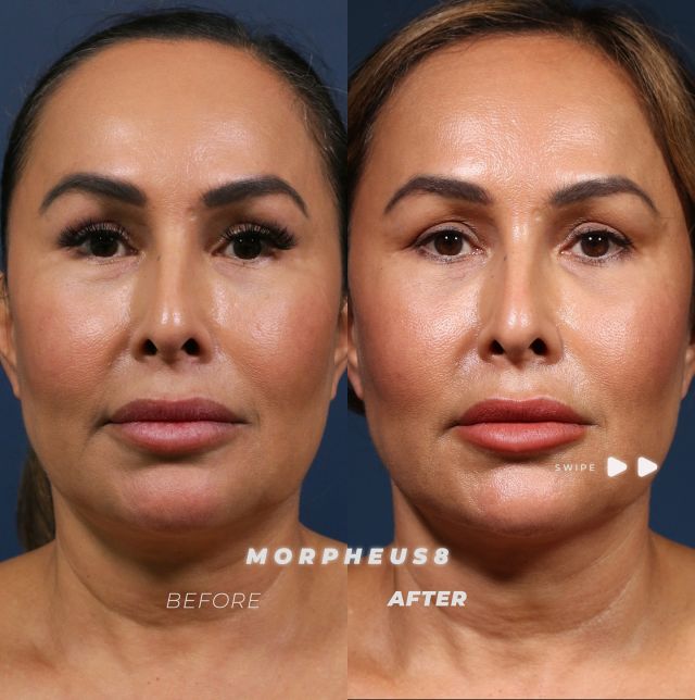 Morpheus8 Results 🤩 // #morpheus8 

✨ Morpheus8 is a microneedling treatment with RF technology that tightens skin, boosts collagen, and improves texture. Suitable for all skin types, it targets areas like the chin, pores, and acne scars. Results start in 3–4 weeks, with 3–4 treatments recommended, making it ideal for those over 30 seeking to maintain youthful skin.

👋BOOK NOW | In-office or virtual appointments by sending your name, number, and email to the DM.

📲 CALL US | questions regarding treatment: (310) 300-1779

🛍 SHOP SKINCARE | Link in bio 🔗 

COMMENT BELOW 🔽
.
.
.
.
#tracelessfacelift #facelift #necklift #skincare #cheeklift #lowerfacelift #laserskinresurfacing #blepharoplasty #upperbleph #uppereyelid #eyelidsurgery  #co2laser #chinaugmentation #skinrejuvenation #skintightening  #cosmeticsurgery #wrinkles  #surgery #rejuvenation #skin #plasticsurgeon #transformation #plasticsurgery