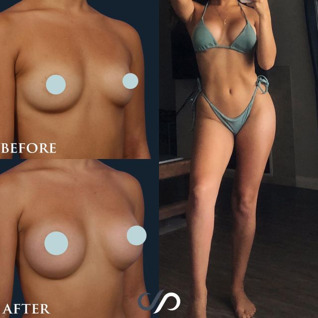 RAPID RECOVERY BREAST AUGMENTATION ✨

Comment below 👇