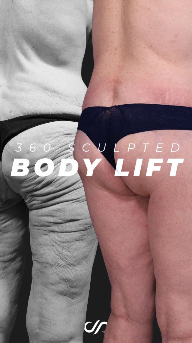 360 Sculpted Body Lift 🤯 // #bbl #liposuction 

🔥 This patient’s transformation just one week after a 360 Sculpted Body Lift is remarkable. We removed excess skin, smoothed cellulite, and refined her figure, giving her a stunning hourglass shape. 

🔥Her buttocks were lifted and sculpted for fuller, more defined curves, and her previous abdominoplasty scar was repositioned for a lower, more discreet look. The results are natural and dramatic, truly rejuvenating her body.

👋BOOK NOW | In-office or virtual appointments by sending your name, number, and email to the DM. 

📲 CALL US | questions regarding treatment: (310) 300-1779

📩Email: Info@drstoker.com

🛍 SHOP SKINCARE | Link in bio 🔗

COMMENT BELOW 🔽 .
.
.
.
#skintightening #abdominoplasty #bodytransformation #plasticsurgery #lowerbody #plasticsurgeon #extendedabdominoplasty  #cosmeticsurgery #surgery #mommymakeover #bodycontouring #breastaugmentation #breastlift  #weightloss #extrememakeover #weightlosstransformation #beforeandafter #bodycontouring #recovery #recoverytime #downtime #body #drstoker #boardcertifiedplasticsurgeon #postopcare #bodyshaping #fitness