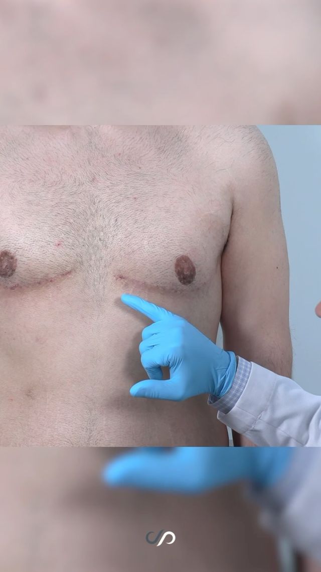 Gynecomastia Surgery 🛠️ 💫 // #gynecomastia 

✨ This 29-year-old male patient, after losing over 120 pounds, underwent an upper body lift and free nipple graft procedure. Following the surgery, he now has a fit, sculpted appearance with well-healed incisions and nipple grafts that have normal sensation. 

✨The results have helped him regain his confidence, allowing him to fully enjoy life without feeling self-conscious about his appearance.

👋BOOK NOW | In-office or virtual appointments by sending your name, number, and email to the DM.

📲 CALL US | questions regarding treatment: (310) 300-1779

🛍 SHOP SKINCARE | Link in bio 🔗

COMMENT BELOW ⬇️  .
.
.
.
#maleplasticsurgery #maleliposuction #malelipo #bodycontouring #transformation #bodygoals #cosmeticsurgery #boardcertified #boardcertifiedplasticsurgeon #beforeandafter #beforeandaftersurgery #stubbornfat #liposuction #liposculpture #lipoformen #athetleticbody #gynecomastiasurgery