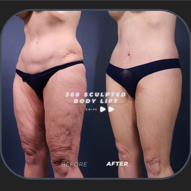 360 Sculpted Body Lift Results ✨ // #bbl #liposuction 

🪄Removal of Excess Skin
🪄Smoothing of Cellulite
🪄Refined Hourglass Shape

👉This patient’s transformation just one week after a 360 Sculpted Body Lift is remarkable. Excess skin was removed, cellulite smoothed, and her figure refined, creating a stunning hourglass shape. Her buttocks were lifted and sculpted for fuller curves, and her abdominoplasty scar was repositioned for a more discreet appearance. The results are both natural and dramatic, rejuvenating her body.

👋BOOK NOW | In-office or virtual appointments by sending your name, number, and email to the DM. 

📲 CALL US | questions regarding treatment: (310) 300-1779

📩Email: Info@drstoker.com

🛍 SHOP SKINCARE | Link in bio 🔗

COMMENT BELOW 🔽 .
.
.
.
#skintightening #abdominoplasty #bodytransformation #plasticsurgery #lowerbody #plasticsurgeon #extendedabdominoplasty  #cosmeticsurgery #surgery #mommymakeover #bodycontouring #breastaugmentation #breastlift  #weightloss #extrememakeover #weightlosstransformation #beforeandafter #bodycontouring #recovery #recoverytime #downtime #body #drstoker #boardcertifiedplasticsurgeon #postopcare #bodyshaping #fitness