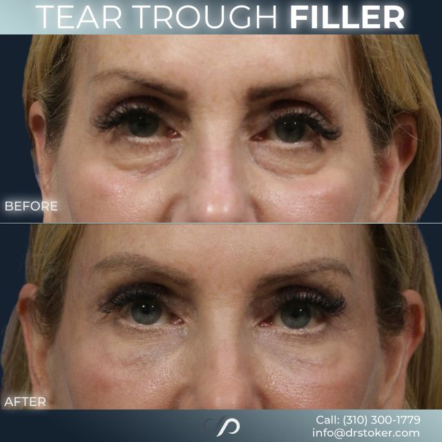 Tear Trough Filler 🤩💉 // #filler #injectables 

✅ We helped our patient achieve a more refreshed, youthful look with tear trough filler. Like many others, she was frustrated by the tired, exhausted appearance caused by under-eye bags. These bags are often a sign of aging, making people feel older than they really are. 

✅ By injecting filler into the tear trough area, we restored volume and smoothness, rejuvenating her facial appearance and leaving her looking well-rested and revitalized.

Visit us at drstoker.com to learn more about our aesthetic treatments. 

Looking For More?🤔
If you’re interested in additional rejuvenation treatments, Botox is worth considering. It works by blocking the nerves in the facial muscles, limiting the movement that causes wrinkles. By targeting fine lines and wrinkles, Botox is an effective way to minimize signs of aging and achieve a smoother, more youthful appearance.

👋BOOK NOW | in-office or virtual appointments by sending your name, number, and email to the DM. 

📲 CALL US | questions regarding treatment: (310) 300-1779

📩Email: Info@drstoker.com

🛍 SHOP SKINCARE | Link in bio 🔗

COMMENT BELOW 🔽
.
.
.
.
#dermalfiller #restylane #restylanel  #undereye #undereyefiller #fillers #teartroughfillers #teartroughs #teartrough #antiaging #aesthetics #undereyefiller #blepharoplasty #upperblepharoplasty #lowerblepharoplasty #juvederm #skin #undereyebags #injectables #plasticsurgery #cheekfiller #botox #lips #undereyecircles #aestheticsexpert  #beforeandafter  #skincareroutine