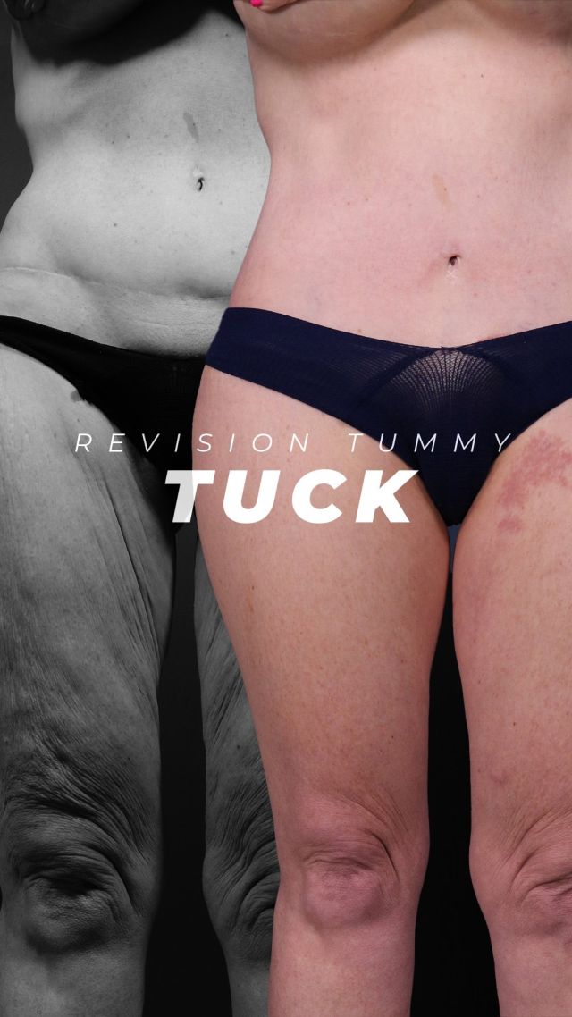 Impressive Tummy Tuck Revision 💕👙💕// #bodylift #transformation

👉 Check out these incredible results! Six weeks after her revision abdominoplasty, she’s already showing definition in her six-pack muscles, with a low incision and no more “dog ears.” Just one week post-op, we’re keeping the surgical tape on for another 2-3 weeks, and the improvement in her inner thighs is remarkable. 

✅ This is a fantastic outcome for her, and it’s been a pleasure working with such a wonderful patient.

👋 BOOK NOW | In-office or virtual appointments by sending your name, number, and email to the DM.

📲 CALL US | questions regarding treatment: (310) 300-1779

🛍 SHOP SKINCARE | Link in bio 🔗

COMMENT BELOW 🔽
.
.
.
.
#skintightening  #bodytransformation #bbl #buttlift #buttockslift #plasticsurgery #lowerbody #tummytuck #plasticsurgeon #abdominoplasty #cosmeticsurgery #surgery #mommymakeover #beauty #physique #weightloss #weightlosstransformation #beforeandafter #bodycontouring #body #thighlift #boardcertifiedplasticsurgeon #bodyshaping #bodygoals #fitness