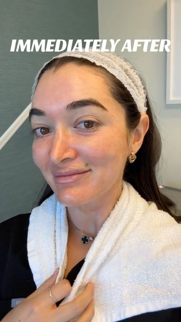 Microneedling with PRP 😍 // #rejuvenation 

🪄 Microneedling is a gentle treatment that uses tiny needles to boost collagen and elastin for smoother, healthier skin. Paired with PRP from your own blood, it accelerates healing and targets specific areas for a radiant, rejuvenated glow.

Helps With? 💫☺️
💕Skin Texture
💕Reducing Pores
💕Collagen Production 

👋 BOOK NOW | In-office or virtual appointments by sending your name, number, and email to the DM.

📲 CALL US | questions regarding treatment: (310) 300-1779

🛍 SHOP SKINCARE | Link in bio 🔗

COMMENT BELOW ⬇️
.
.
.
.
#microneedling #skincare #acnescars #facialrejuvenation #aesthetics #beauty #dermapen #glowingskin #skintreatment #skincareroutine #collagenproduction #vampirefacial #microneedlingfacial #beautytreatment #kimkardashian  #microneedlingbeforeandafter #microneedlingresults #beautyhacks