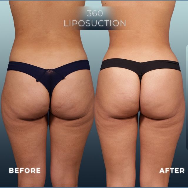 Amazing 360-Degree Liposuction✨ // #bbl #liposuction 

RESULTS👋
🪄Flatter Stomach
🪄Slimmer Waist
🪄Toned Thighs
🪄Enhanced Natural Curves

✅ We have a three-month post-op update on a 25-year-old patient who had 360-degree power-assisted liposuction before her wedding. The procedure sculpted her lower abdomen, waist, and thighs, creating a flatter stomach, slimmer waist, and toned thighs. Even at her ideal weight and in great shape, she chose liposuction to refine her figure and achieve her desired contours.

👋BOOK NOW | In-office or virtual appointments by sending your name, number, and email to the DM. 

📲 CALL US | questions regarding treatment: (310) 300-1779

📩Email: Info@drstoker.com

🛍 SHOP SKINCARE | Link in bio 🔗

COMMENT BELOW 🔽 .
.
.
.
#skintightening #abdominoplasty #bodytransformation #plasticsurgery #lowerbody #plasticsurgeon #extendedabdominoplasty  #cosmeticsurgery #surgery #mommymakeover #bodycontouring #breastaugmentation #breastlift  #weightloss #extrememakeover #weightlosstransformation #beforeandafter #bodycontouring #recovery #recoverytime #downtime #body #drstoker #boardcertifiedplasticsurgeon #postopcare #bodyshaping #fitness