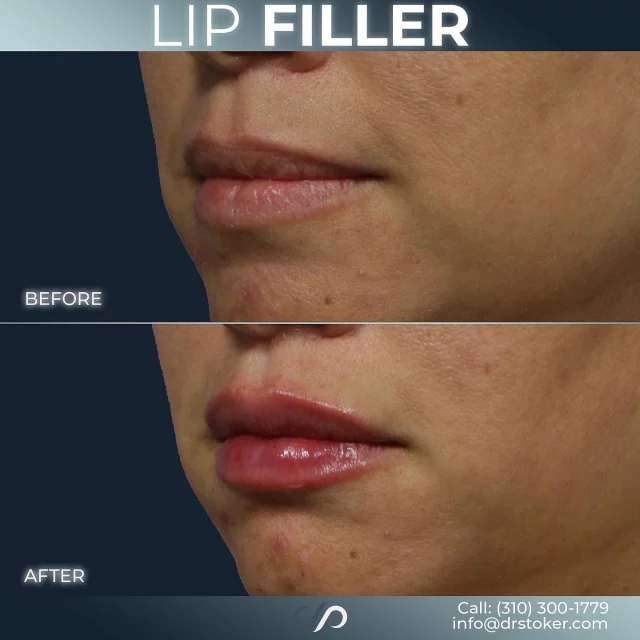 Lip Filler ✨💋 // #lipfiller #enhancement

RESULTS 💉👄 
✨Enhanced Volume & Definition 
✨Smoother, Wrinkle-Free Lips 
✨Natural-Looking Results

BONUS 🌟 If you want to tackle wrinkles and fine lines, Botox is a great option! It works by blocking nerve signals to reduce muscle movement and lessen the appearance of wrinkles.

Visit our website, drstoker.com, to view striking before and after photos and discover our full range of rejuvenation services. Start your journey to a more youthful look today!

BOOK NOW | in-office or virtual appointments by sending your name, number, and email to the DM. 

📲 CALL US | questions regarding treatment: (310) 300-1779

📩Email: Info@drstoker.com

🛍 SHOP SKINCARE | Link in bio 🔗

COMMENT BELOW 🔽
.
.
.
.
#lipfillerbeforeandafter #dermalfiller #cosmeticinjector #juvederm #restylanel #juvedermultra  #fillers #filler #lipflip #plumplips #lipaugmentation #lipfillers #lipenhancement #antiaging #aesthetics #lipgoals #lipenvy #skin #injectables #plasticsurgery #cheekfiller #lips #aestheticsexpert #selfcare #beforeandafter #skincareroutine