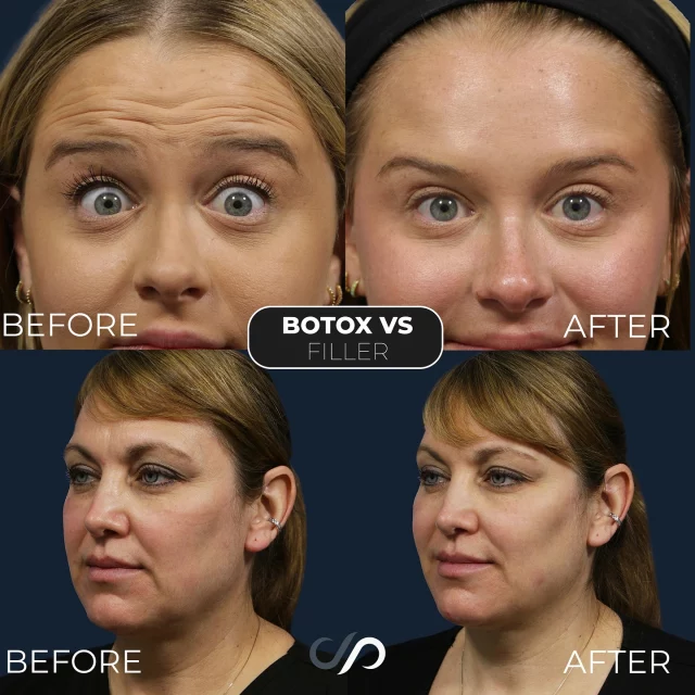 Filler vs. Botox ✨💉💞 // #filler #botox #medspa 

Where To Get Filler ❤️
💉 Lips
💉 Cheeks
💉 Under Eyes 
💉 Nasolabial Folds
💉Jawline 

Where To Get Botox 💝
💉 Crow’s Feet
💉 Forehead Lines
💉 Neck Bands
💉 Lip Lines

BOOK NOW | in-office or virtual appointments by sending your name, number, and email to the DM. 

📲 CALL US | questions regarding treatment: (310) 300-1779

📩Email: Info@drstoker.com

🛍 SHOP SKINCARE | Link in bio 🔗

COMMENT BELOW 🔽
.
.
.
.
#dermalfiller #botox #beauty #antiaging #aesthetics #fillers #undereyefiller #dermalfiller #medicalspa #juvederm #skin #lipfiller #injectables #plasticsurgery #facial #cheekfiller #lips #esthetician #aestheticsexpert #facials #dermalfillers #selfcare #microneedling #dysport #bodycontouring #restylane #laser #skincareroutine