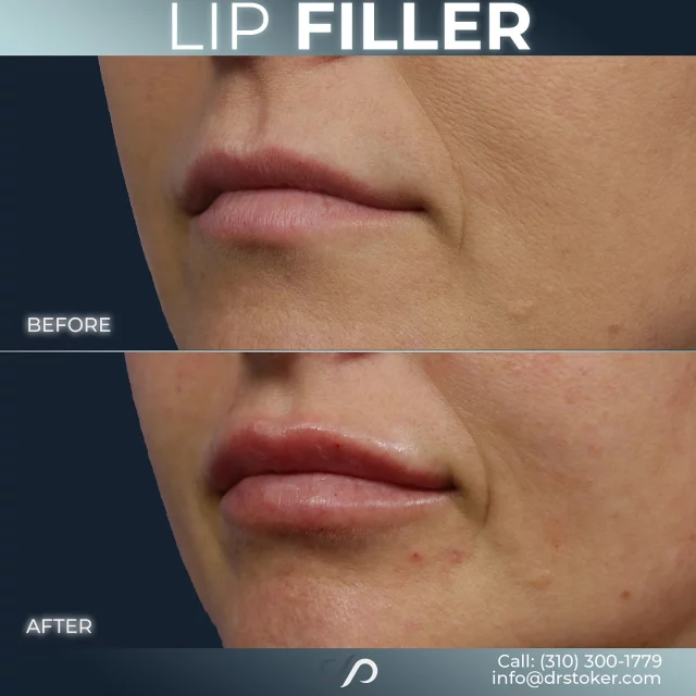 Lip Filler Enhancement ✨💋✨// #lipfiller #enhancement

RESULTS 💉👄 
✨	Enhanced Lip Volume
✨ Improved Shape & Definition
✨ Smooths Fine Lines
✨ Immediate Results
✨ Minimal Downtime

👉 Lip filler treatments enhance lip volume and shape using hyaluronic acid injectables, creating a fuller, natural look with minimal downtime. Results are immediate and customizable for a subtle or dramatic boost.

✅ Visit our website, drstoker.com, to view striking before and after photos and discover our full range of rejuvenation services. Start your journey to a more youthful look today!

👋 BOOK NOW | in-office or virtual appointments by sending your name, number, and email to the DM. 

📲 CALL US | questions regarding treatment: (310) 300-1779

📩Email: Info@drstoker.com

🛍 SHOP SKINCARE | Link in bio 🔗

COMMENT BELOW 🔽
.
.
.
.
#lipfillerbeforeandafter #dermalfiller #cosmeticinjector #juvederm #restylanel #juvedermultra  #fillers #filler #lipflip #plumplips #lipaugmentation #lipfillers #lipenhancement #antiaging #aesthetics #lipgoals #lipenvy #skin #injectables #plasticsurgery #cheekfiller #lips #aestheticsexpert #selfcare #beforeandafter #skincareroutine