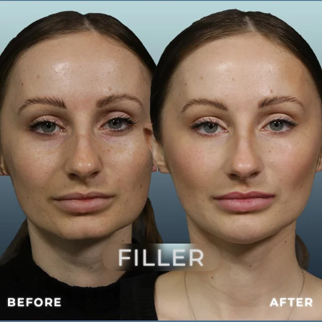 Filler For Facial Enhancement 💉✨ // #filler #medspa 

✨Dermal fillers replenish lost collagen and elastin, reducing wrinkles and fine lines by plumping and tightening the skin. They provide a rejuvenated appearance and enhance facial symmetry by adding volume to areas like the cheeks or chin, sculpting the face. Enjoy immediate results and zero downtime with our popular dermal filler treatments for a radiant, youthful look!

👋BOOK NOW | In-office or virtual appointments by sending your name, number, and email to the DM. 

📲 CALL US | questions regarding treatment: (310) 300-1779

📩Email: Info@drstoker.com

🛍 SHOP SKINCARE | Link in bio 🔗

COMMENT BELOW 🔽
.
.
.
.
#dermalfiller #botox #beauty #antiaging #aesthetics #fillers #undereyefiller #dermalfiller #medicalspa #juvederm #skin #lipfiller #injectables #plasticsurgery #facial #cheekfiller #lips #esthetician #aestheticsexpert #facials #dermalfillers #selfcare #microneedling #dysport #bodycontouring #restylane #laser #skincareroutine