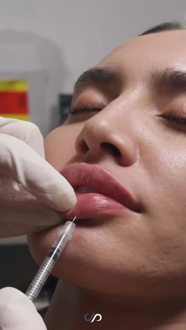 Lip Filler 💉👄 // #lipfiller #enhancement 

Benefits of Lip Filler💋✨
💖Enhanced Volume
💖Improved Proportion
💖Hydrated Appearance 
💖Improved & Defined Lip lines

👋BOOK NOW | in-office or virtual appointments by sending your name, number, and email to the DM. 

📲 CALL US | questions regarding treatment: (310) 300-1779

📩Email: Info@drstoker.com

🛍 SHOP SKINCARE | Link in bio 🔗

COMMENT BELOW 🔽
.
.
.
.
#lipfillerbeforeandafter #dermalfiller #cosmeticinjector #juvederm #restylanel #juvedermultra  #fillers #filler #lipflip #plumplips #lipaugmentation #lipfillers #lipenhancement #antiaging #aesthetics #lipgoals #lipenvy #skin #injectables #plasticsurgery #treatyoself #cheekfiller #lips #aestheticsexpert #selfcare #beforeandafter #skincareroutine