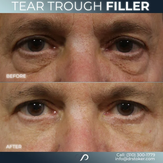 Tear Trough Filler 🤩💉 // #filler #injectables 

✅ Tear trough filler is a popular treatment for those seeking a refreshed, youthful appearance, especially for individuals bothered by under-eye bags. These bags are commonly associated with aging and can make people appear more tired or older than they feel. 

✅ By injecting filler into the tear trough area, volume and smoothness are restored, helping to rejuvenate the face. The result is a more rested, revitalized look that enhances overall facial harmony.

Visit us at drstoker.com to learn more about our aesthetic treatments. 

👋BOOK NOW | in-office or virtual appointments by sending your name, number, and email to the DM. 

📲 CALL US | questions regarding treatment: (310) 300-1779

📩Email: Info@drstoker.com

🛍 SHOP SKINCARE | Link in bio 🔗

COMMENT BELOW 🔽
.
.
.
.
#dermalfiller #restylane #restylanel  #undereye #undereyefiller #fillers #teartroughfillers #teartroughs #teartrough #antiaging #aesthetics #undereyefiller #blepharoplasty #upperblepharoplasty #lowerblepharoplasty #juvederm #skin #undereyebags #injectables #plasticsurgery #cheekfiller #botox #lips #undereyecircles #aestheticsexpert  #beforeandafter  #skincareroutine