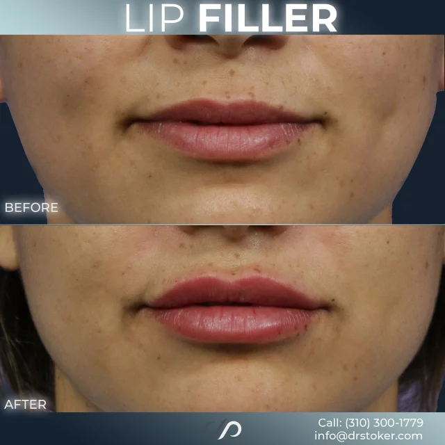 Lip Filler 👄✨// #lipfiller #enhancement

💕 Lip fillers are a minimally invasive treatment that enhances lip volume, shape, and symmetry using hyaluronic acid-based injectables. The procedure provides immediate results with little downtime, improving lip contours and stimulating collagen production for long-lasting, natural-looking effects.

✅ Visit our website, drstoker.com, to view striking before and after photos and discover our full range of rejuvenation services. Start your journey to a more youthful look today!

👋 BOOK NOW | in-office or virtual appointments by sending your name, number, and email to the DM. 

📲 CALL US | questions regarding treatment: (310) 300-1779

📩Email: Info@drstoker.com

🛍 SHOP SKINCARE | Link in bio 🔗

COMMENT BELOW 🔽
.
.
.
.
#lipfillerbeforeandafter #dermalfiller #cosmeticinjector #juvederm #restylanel #juvedermultra  #fillers #filler #lipflip #plumplips #lipaugmentation #lipfillers #lipenhancement #antiaging #aesthetics #lipgoals #lipenvy #skin #injectables #plasticsurgery #cheekfiller #lips #aestheticsexpert #selfcare #beforeandafter #skincareroutine