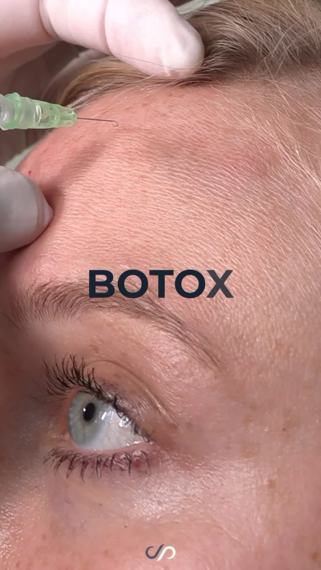 Ask Us About Botox ✨ // #Botox #wrinklefree

What Are The Benefits of Botox? 🪄
💉 Diminishes Fine Lines & Wrinkles
💉 Minimizes the Appearance of Crow’s Feet
💉 Visible Results in 24-48 Hours

✨ Refresh your look with Botox, a safe and effective way to smooth fine lines and wrinkles, leaving you with youthful, radiant skin and boosted confidence.

👋 BOOK NOW | In-office or virtual appointments by sending your name, number, and email to the DM. 

📲 CALL US | questions regarding treatment: (310) 300-1779

📩Email: Info@drstoker.com

🛍 SHOP SKINCARE | Link in bio 🔗

COMMENT BELOW 🔽
.
.
.
.
#preventativebotox #botox #antiaging #dysport #crowsfeet #skincare #botoxinjections #injectables #injections #botoxforehead #wrinkles #frownlines #beauty #fillers #xeomin #aesthetics #beforeandafter #wrinklefree #refresh #prevention #botoxbeforeandafter #botoxcosmetic