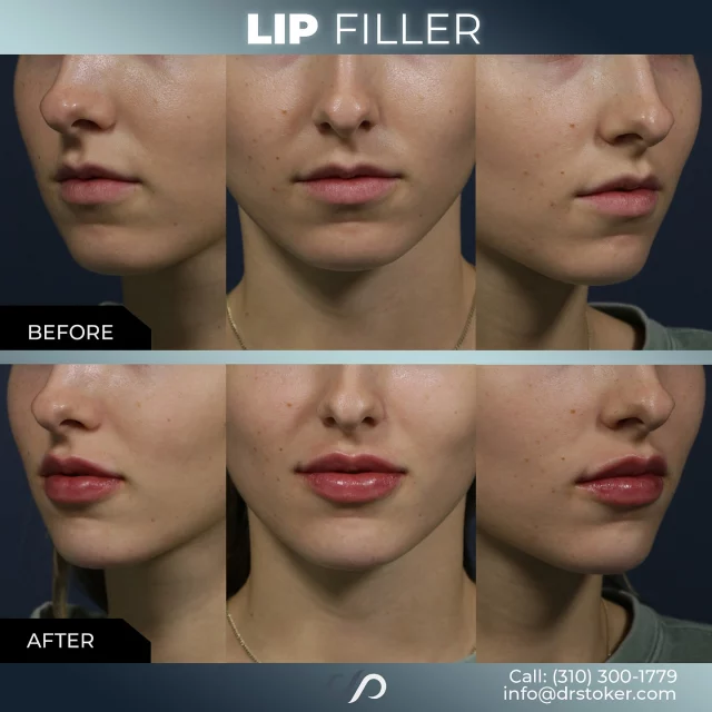 Lip Filler 👄✨// #lipfiller #enhancement

✨Instant Results
✨Non-Invasive
✨Customizable 

❣️ Lip fillers are a popular, non-surgical solution for enhancing the appearance of your lips. Using hyaluronic acid-based injectables, this treatment adds volume, defines shape, and restores symmetry to your lips for a fuller, youthful look.

✅ Visit our website, drstoker.com, to view striking before and after photos and discover our full range of rejuvenation services. Start your journey to a more youthful look today!

👋 BOOK NOW | in-office or virtual appointments by sending your name, number, and email to the DM. 

📲 CALL US | questions regarding treatment: (310) 300-1779

📩Email: Info@drstoker.com

🛍 SHOP SKINCARE | Link in bio 🔗

COMMENT BELOW 🔽
.
.
.
.
#lipfillerbeforeandafter #dermalfiller #cosmeticinjector #juvederm #restylanel #juvedermultra  #fillers #filler #lipflip #plumplips #lipaugmentation #lipfillers #lipenhancement #antiaging #aesthetics #lipgoals #lipenvy #skin #injectables #plasticsurgery #cheekfiller #lips #aestheticsexpert #selfcare #beforeandafter #skincareroutine